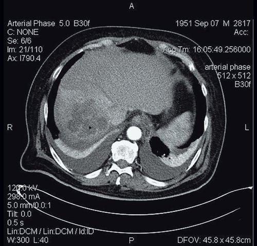 КТ-картина абсцесса печени - артериальная фаза