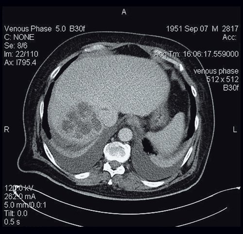 КТ-картина абсцесса печени - венозная фаза, при контрастировании определяется периферический тип накопления (кольцевидное контрастное усиление по периферии) по типу капсулы