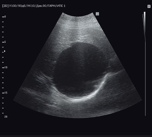 Эхограмма эхинококковой кисты, стадия CE1 - однокамерное кистозное образование сферической формы с единичными гиперэхогенными включениями («гидатидный песок»)