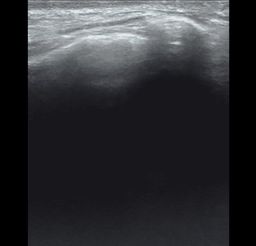 Правосторонний экссудативный верхнечелюстной синусит - эхограмма правой верхнечелюстной пазухи в В-режиме после лечения