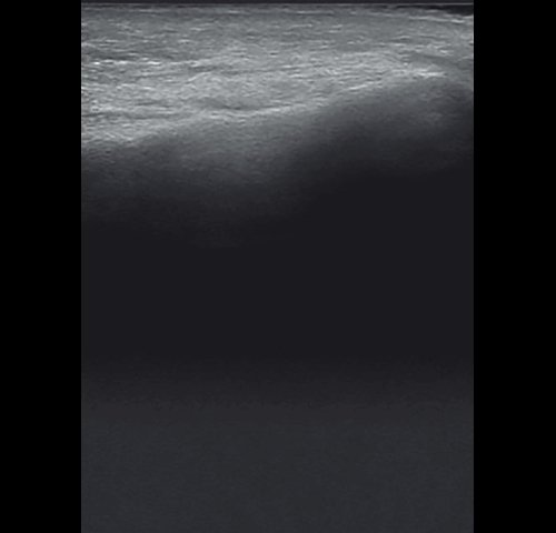 Правосторонний экссудативный верхнечелюстной синусит - эхограмма левой верхнечелюстной пазухи в В-режиме после лечения