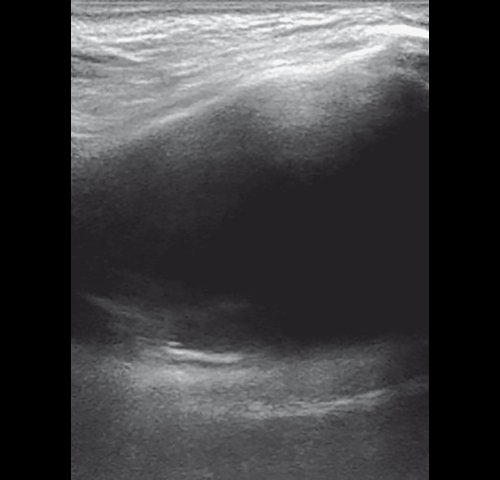 Правосторонний экссудативный верхнечелюстной синусит - эхограмма правой верхнечелюстной пазухи в В-режиме до лечения