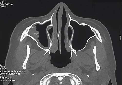 Неинвазивный грибковый верхнечелюстной синусит - МСКТ придаточных пазух носа (аксиальная проекция)