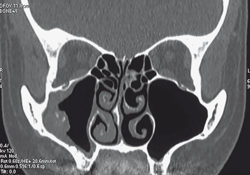 Неинвазивный грибковый верхнечелюстной синусит - МСКТ придаточных пазух носа (фронтальная про-
                                    екция)
