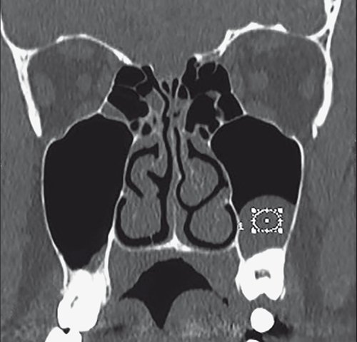 Кисты верхнечелюстных пазух - МСКТ придаточных пазух носа (фронтальная проекция)