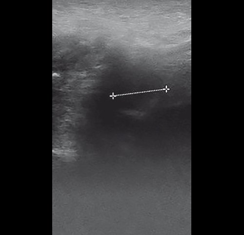 Правосторонний экссудативный верхнечелюстной синусит - эхограмма правой верхнечелюстной пазухи в В-режиме после лечения (аксиальная проекция)