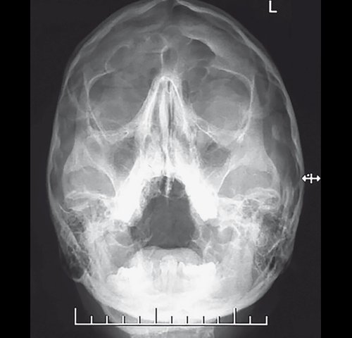 Полипозный полисинусит - рентгенограмма придаточных пазух носа до лечения