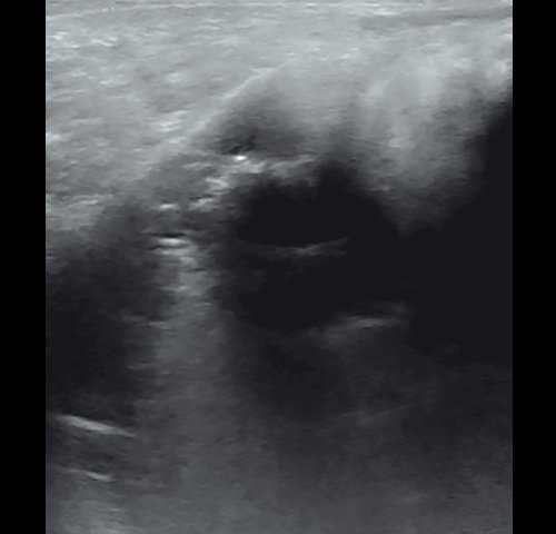 Полипозный полисинусит - эхограмма левой верхнечелюстной пазухи в В-режиме до лечения (сагиттальная проекция)