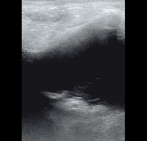 Полипозный полисинусит - эхограмма левой верхнечелюстной пазухи, заполненной раствором диоксидина, в В-режиме через 4 дня от начала лечения (сагиттальная проекция)