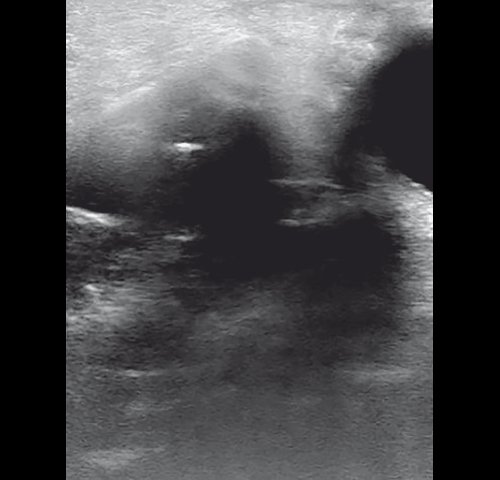 Полипозный полисинусит - эхограмма левой верхнечелюстной пазухи в В-режиме через 8 дней от начала лечения (сагиттальная проекция)