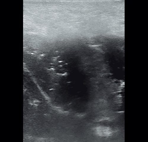 Полипозный полисинусит - эхограмма левой верхнечелюстной пазухи в В-режиме через 4 дня от начала лечения (аксиальная проекция)
