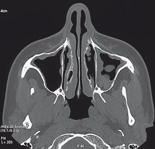 Полипозный полисинусит - МСКТ придаточных пазух носа (аксиальная проекция)