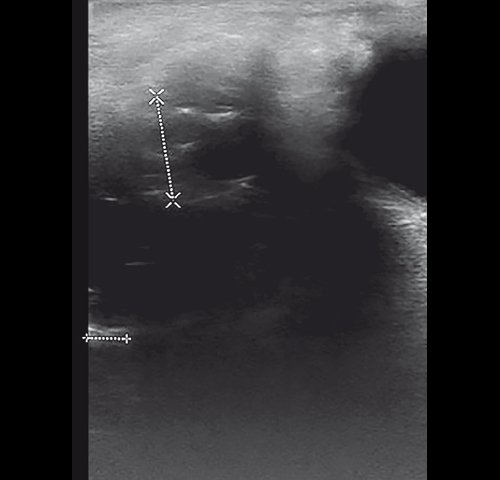 Полипозный полисинусит - эхограмма левой верхнечелюстной пазухи в В-режиме через 15 дней от начала лечения (сагиттальная проекция)