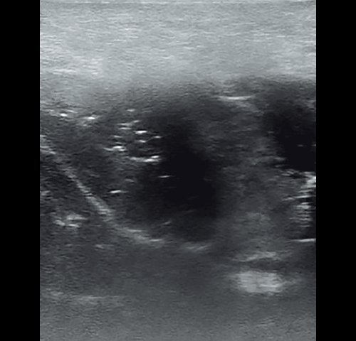Полипозный полисинусит - эхограмма левой верхнечелюстной пазухи в В-режиме до лечения (аксиальная проекция)