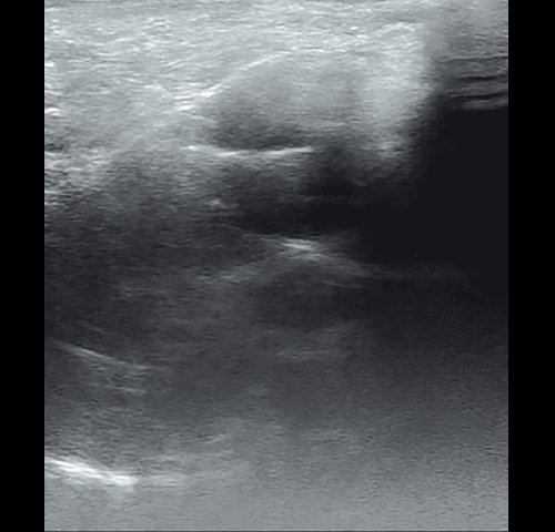 Полипозный полисинусит - эхограмма левой верхнечелюстной пазухи в В-режиме через 36 дней от начала лечения (сагиттальная проекция)