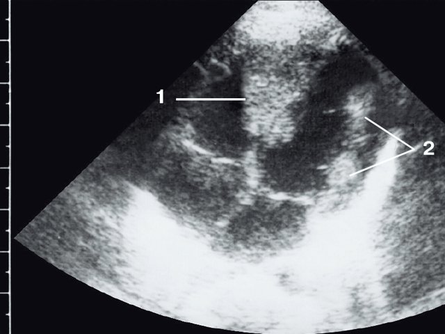 Эхокардиограмма ребенка (девочки) с рабдомиомой - крупный узел рабдомиомы в межжелудочковой перегородке (1) и менее крупные узлы в задней стенке левого желудочка (2)