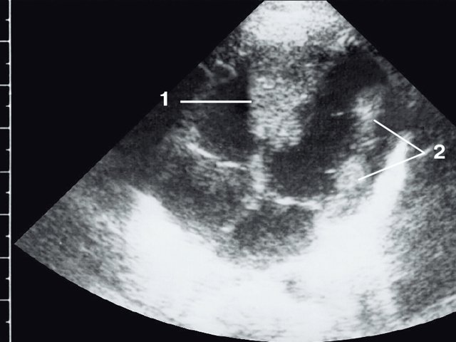Эхокардиограмма матери этого же ребенка - в межжелудочковой перегородке несколько эхоплотных образований (стрелки)