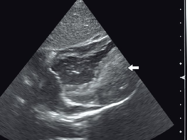 Эхокардиограмма гигантской рабдомиомы (стрелка) у девочки марфаноидного статуса без признаков туберозного склероза (субксифоидальный доступ)