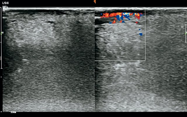 Эхограмма опухолевых изменений слизистой языка (режим ЦДК, линейный датчик)