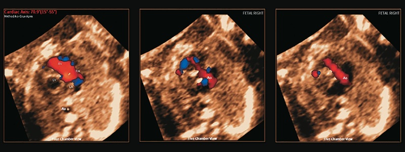 Эхограммы сердца плода: при гипоплазии левых отделов сердца в диагностических плоскостях отсутствует заполнение цветом левосторонних структур в четырехкамерной проекции (левая панель) и цветового потока в восходящей аорте в пятикамерной проекции (средняя и правая панели)