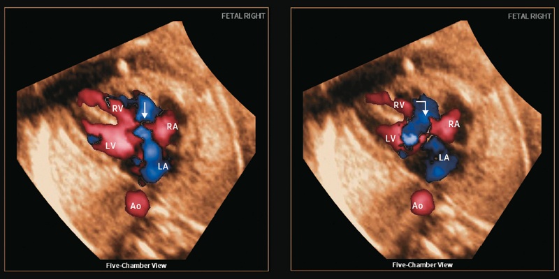 Эхограммы: ЦДК кровотока у плода с удвоением выносящего тракта правого желудочка (double outlet right ventricle – DORV). В пятикамерной проекции видны отсутствие выходных сосудов из левого желудочка, но выход сосудов из правого желудочка (левая панель, прямая стрелка) и дополнительный крупный перимембранозный ДМЖП (правая панель, угловая стрелка)