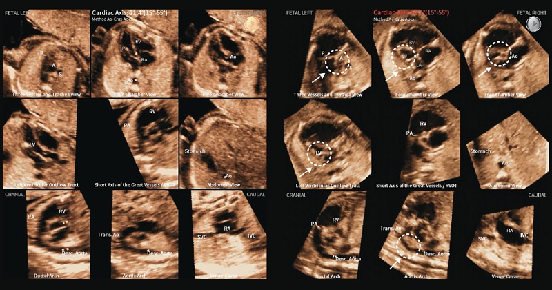 Эхограммы: сравнение нормального сердца плода в приложении 5D Heart (левая панель) и на реконструированных диагностических плоскостях при гипоплазии левых отделов сердца (правая панель), гипоплазированные левосторонние структуры обведены кружком (стрелка)