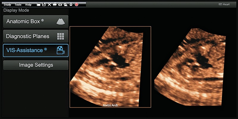 Скриншот: реконструированная диагностическая плоскость дуги аорты (левая панель) и соответствующее изображение после корректировки с помощью VIS-Assistance, видна нормальная форма дуги аорты (правая панель)