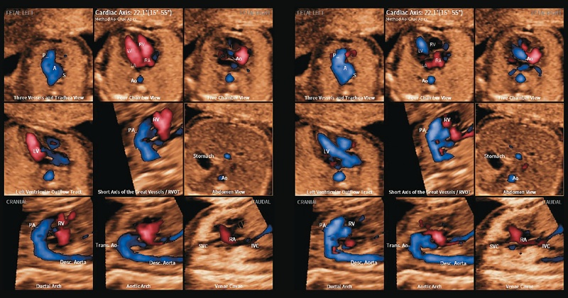 УЗИ сердца плода - 5D Heart Color в диастолу (левая панель) и в систолу (правая панель)