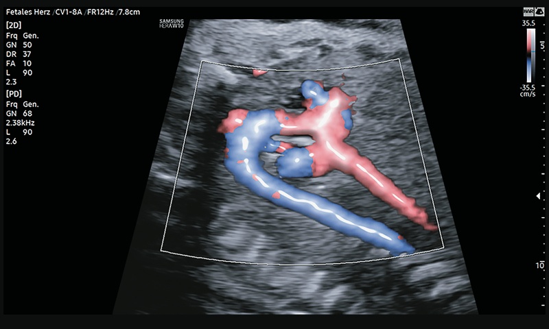 УЗИ сердца плода (B-режим + LumiFlow) - дуги аорты (нижняя панель)