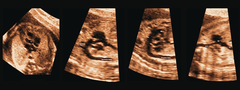 УЗИ сердца плода - пятикамерная проекция, дуга аорты, дуга грудного протока и бикавальная проекция, полученные при полуавтоматической реконструкции с использованием метода 5D Heart (слева направо)