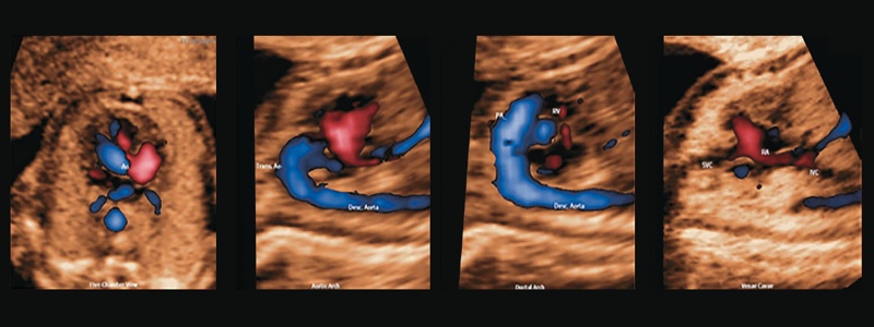 УЗИ сердца плода - пятикамерная проекция с ЦДК, дуга аорты, дуга протока и бикавальная проекция и соответствующее цветовое картирование кровотока после применения технологии 5D Heart Color к данным STIC с ЦДК
