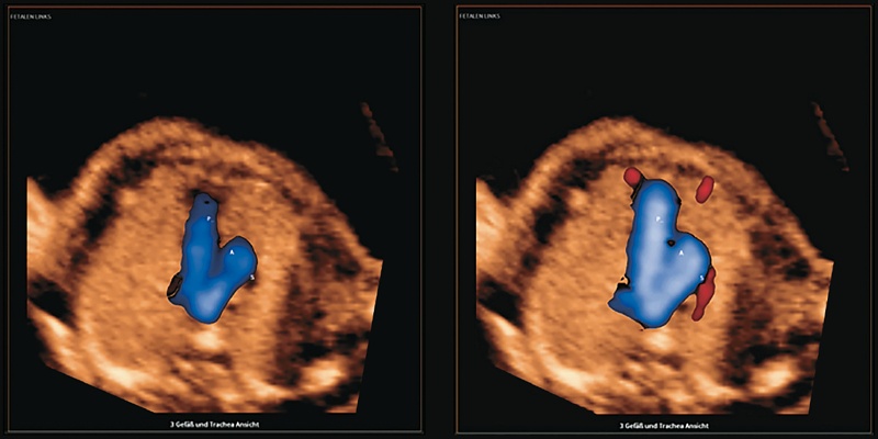 Эхограммы: срез через 3 сосуда и трахею (3VT) - видно v-образное соединение общей легочной артерии и поперечной части дуги аорты через артериальный проток (левая панель), приток по V. azygos в верхнюю полую вену во время сердечного цикла (правая панель)
