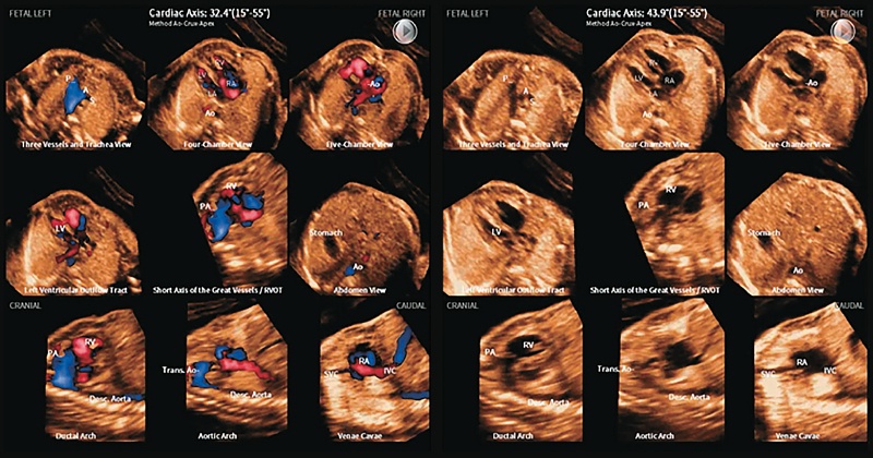 Объемные изображения STIC плода с коарктацией аорты, повторно послойно перекомбинированные
                            с использованием 5D Heart Color (левая панель) и 5D Heart (правая панель)