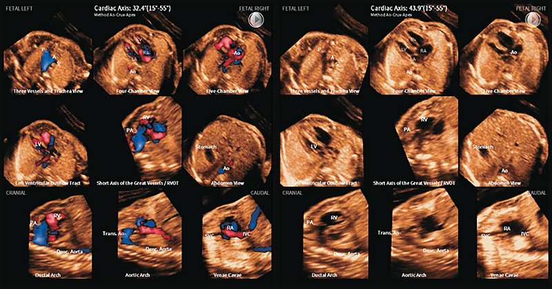 Объемные изображения STIC плода с коарктацией аорты, повторно послойно перекомбинированные
                                с использованием 5D Heart Color (левая панель) и 5D Heart (правая панель)