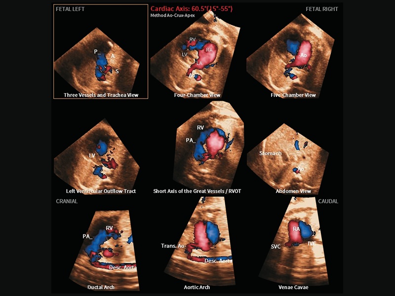 УЗИ сердца у плода с гипоплазией левых отделов сердца, вызванной атрезией митрального клапана и аорты (5D Heart Color)