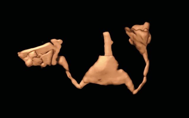 4D HyCoSy эхограмма - видны обе маточные трубы на всем протяжении, истечение контрастного вещества за край фимбрий (3)