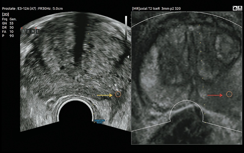 Предстательная железа: слева - УЗИ в В-режиме (гипоэхогенное образование), справа - МРТ (заподозрена периферическая карцинома)