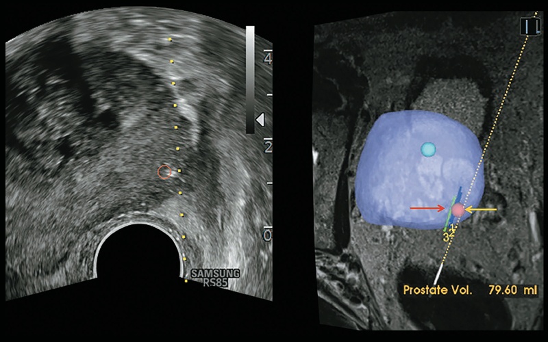 3D-моделирование предстательной железы: слева - УЗИ, справа - МРТ (подозрительное образование помечено в виде сферы красного цвета)