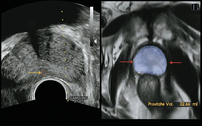 Технология автокалибровки S-Fusion™ для предстательной железы: слева - УЗИ, справа - МРТ (система автоматически определяет контур предстательной железы и измеряет ее объем)