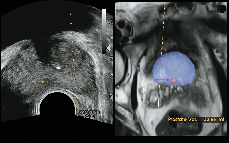 Технология S-Fusion™ для предстательной железы: слева - УЗИ (поражение-мишень - желтая стрелка), справа - МРТ (красная стрелка - 3D-объем)