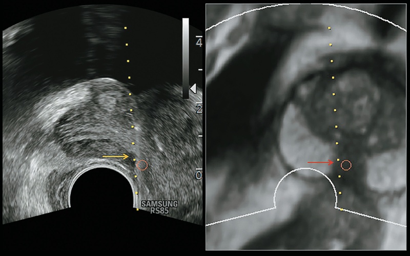 Низкодифференцированная ацинарная карцинома предстательной железы: слева - УЗИ, справа - МРТ (по шкале Глисона 4 + 4 = 8 баллов)