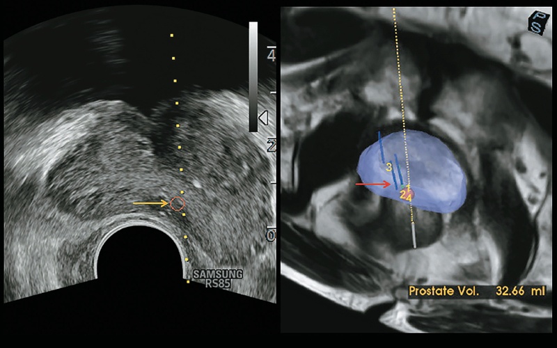 Комбинированная визуализация предстательной железы (подозрительное образование): слева - УЗИ (желтая стрелка) , справа - МРТ (сфера красного цвета)