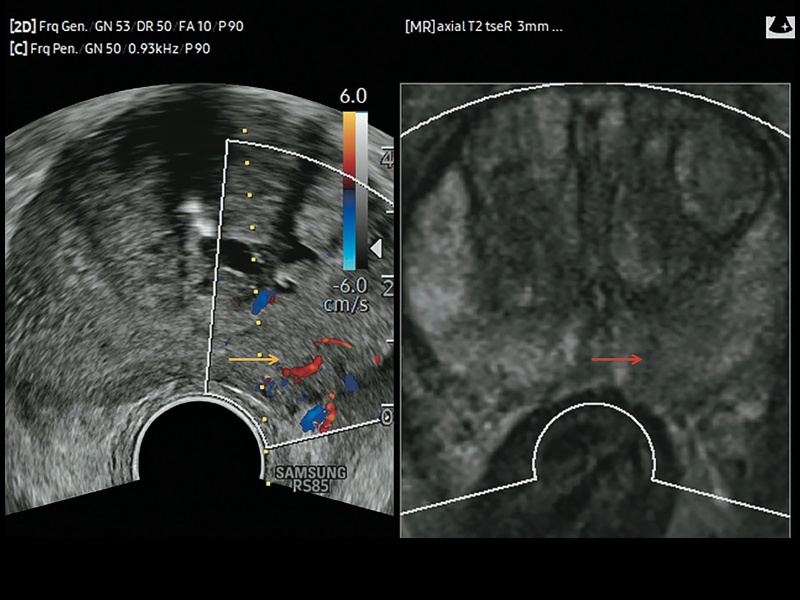 Предстательная железа: слева УЗИ в B-режиме + ЦДК (выявлено образование с повышенной васкуляризацией), справа - МРТ (заподозрен рак)