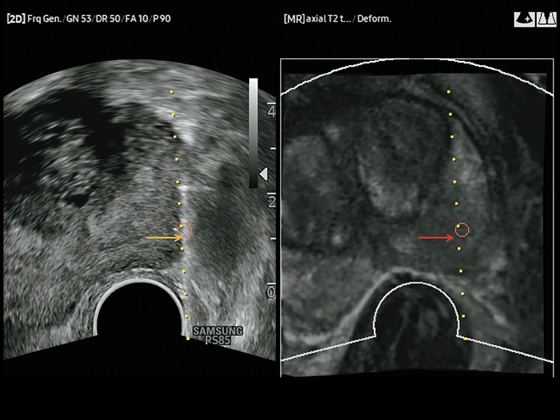 Ацинарная аденокарцинома предстательной железы: слева УЗИ, справа - МРТ (красные и желтые стрелки)