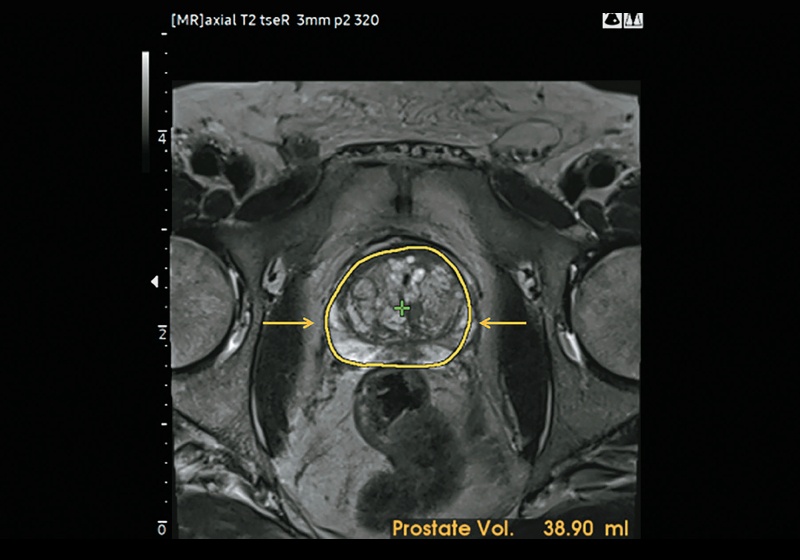 МРТ: алгоритм автоматической калибровки улучшает выявление контура предстательной железы (желтые стрелки)
                                и автоматически вычисляет объем предстательной железы (38,90 мл)