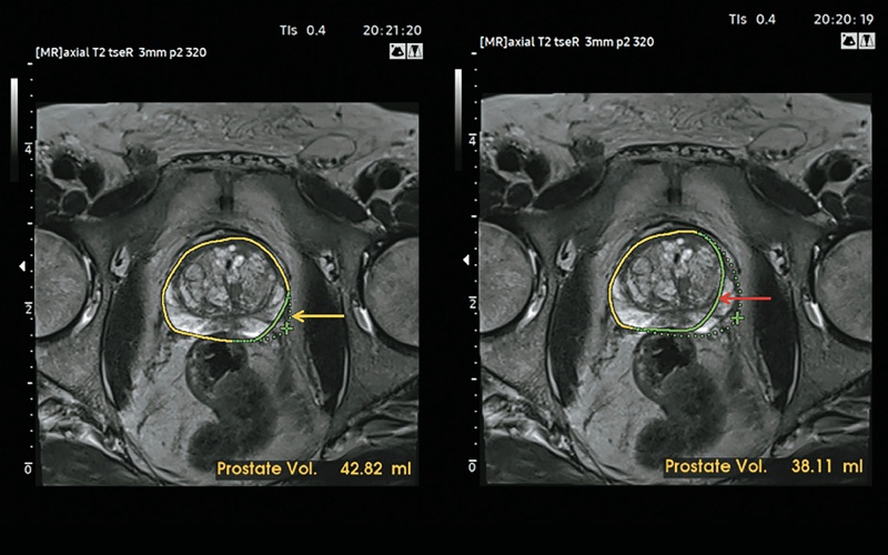 МРТ: чтобы рассчитать объем предстательной железы, можно немного (желтая стрелка) или значительно (красная стрелка) исправить ее контур вручную
