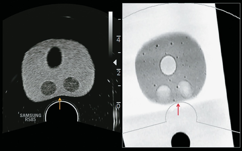 Во время исследования датчик сдавливает ткань предстательной железы (желтая стрелка), деформируя ее
                                и нарушая соответствие между данными УЗИ и МРТ (красная стрелка)