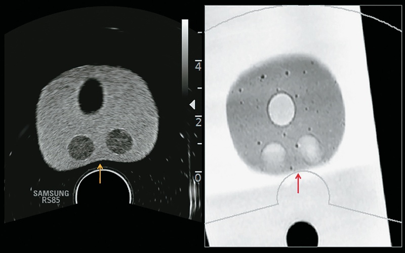 Во время исследования датчик сдавливает ткань предстательной железы (желтая стрелка), деформируя ее
                                и нарушая соответствие между данными УЗИ и МРТ (красная стрелка)
