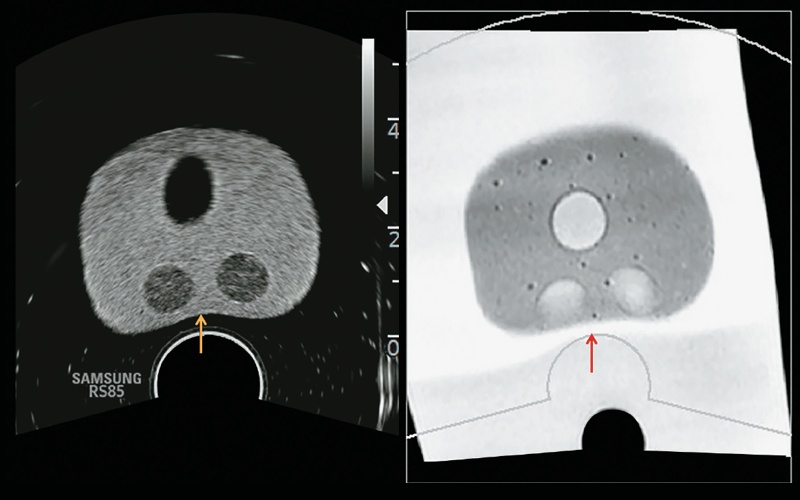 Алгоритм коррекции деформации в системе позволяет повысить точность регистрации, корригируя деформацию предстательной железы на МР-изображении (красная стрелка) при сдавлении ткани датчиком (желтая стрелка) во время исследования