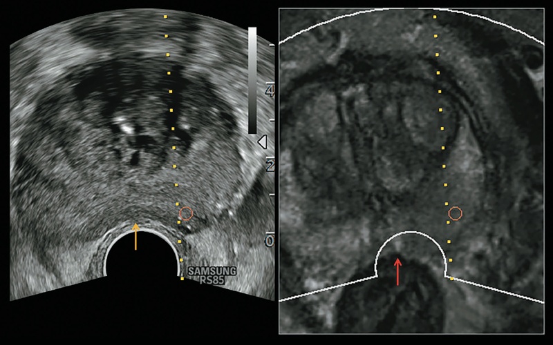 Во время исследования датчик сдавливает ткань предстательной железы (желтая стрелка), вызывая несоответствие между местоположением предстательной железы и контуром предстательной железы на МР-изображении (красная стрелка)